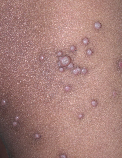 Molluscum contagiosum in a child. The image demonstrates the typical pearly papules with umbilicated centres
