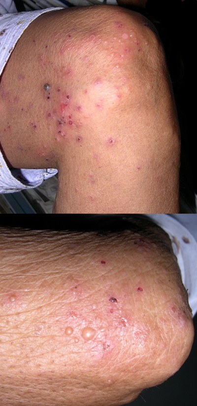 Dermatitis herpetiformis in a middle-aged female who presented with pruritic vesicles on her knees and elbows. Image used on license from DermNet NZ