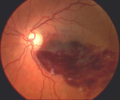 Fundoscopy showing branch retinal vein occlusion