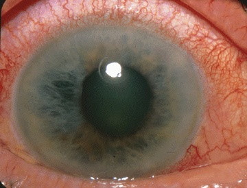 Photograph showing acute angle-closure glaucoma