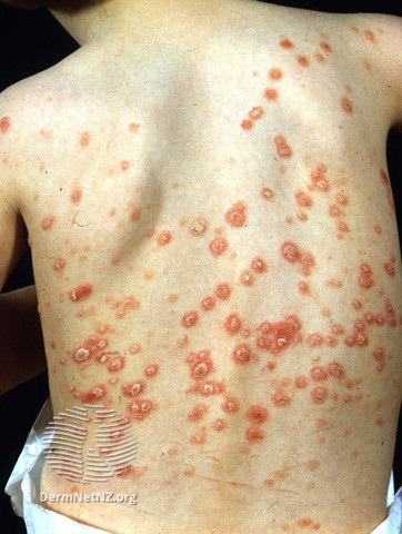 dermnet psoriasis guttate)