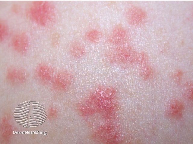 dermnet psoriasis guttate