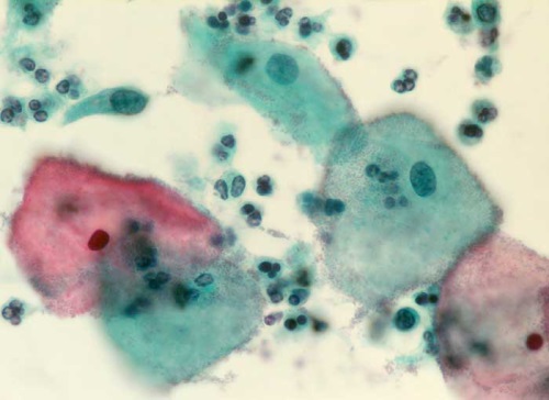 Clue cells - epithelial cells develop a stippled appearance due to being covered with bacteria