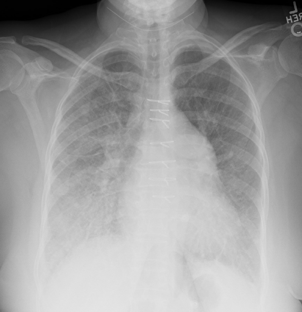 Chest X-ray showing pulmonary oedema