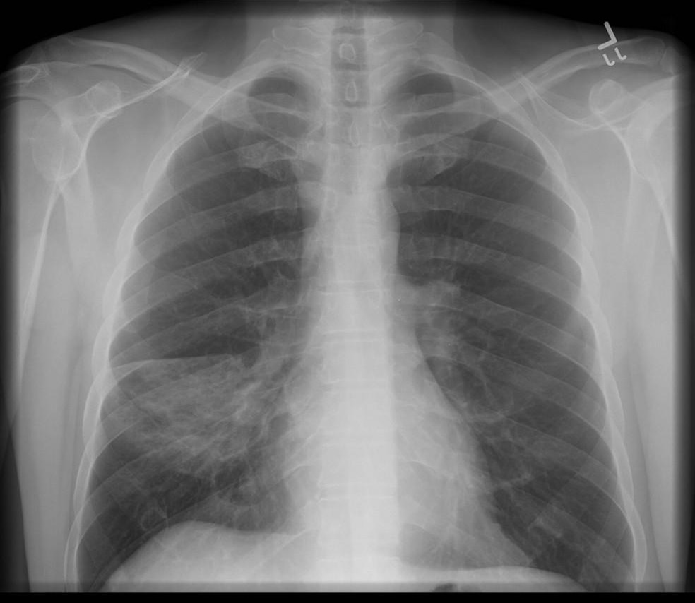 Chest X-ray showing pneumonia consolidation