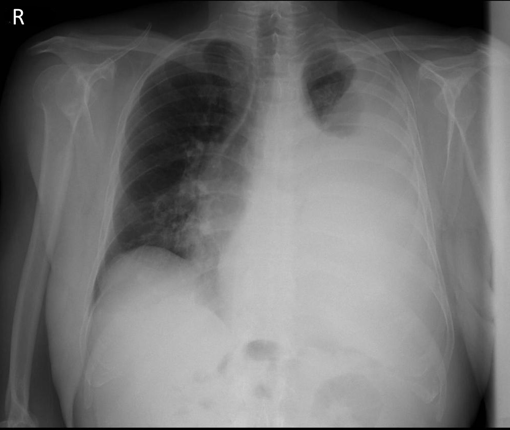 Chest X-ray showing pleural effusion
