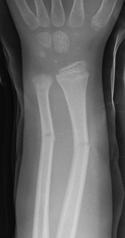 Greenstick fracture - e Image used on license from Radiopaedia
