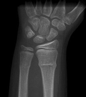 Buckle (torus) fracture - e Image used on license from Radiopaedia
